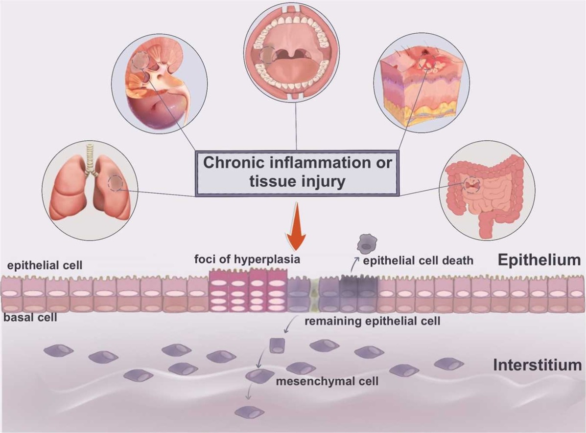 Check out this interesting review on the role of epithelial cells on fibrosis progression and treatment: doi.org/10.1016/j.phrs… #fibrosis #epithelialcells #PharmacolRes #openaccess #Research #PharmaTwitter #MedTwitter