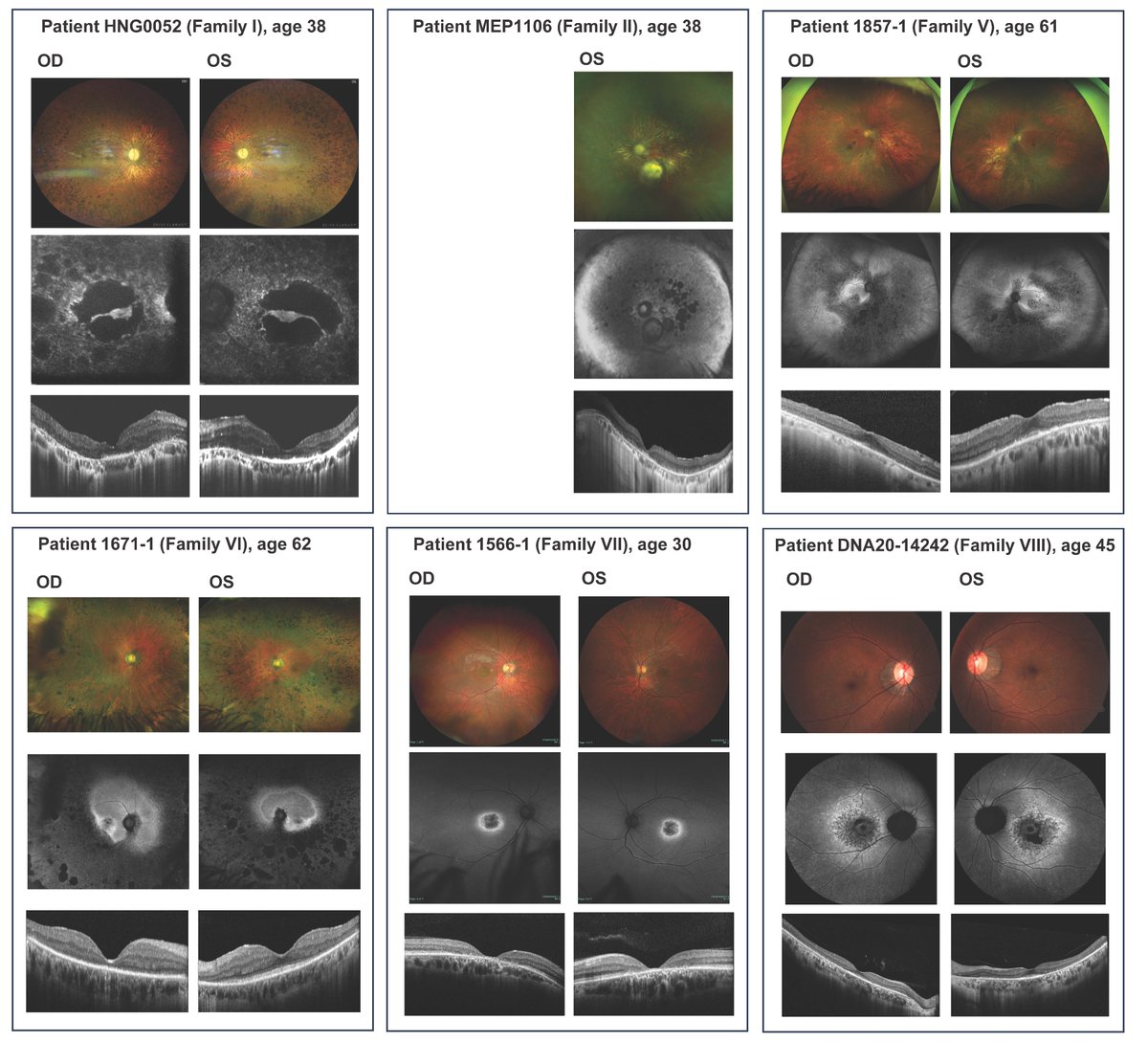 Study finds link between biallelic LoF variants in #UBAP1L and a nonsyndromic retinal degeneration phenotype bit.ly/3PREQE1 #IRD #retinitispigmentosa #rodconedystrophy #coneroddystrophy