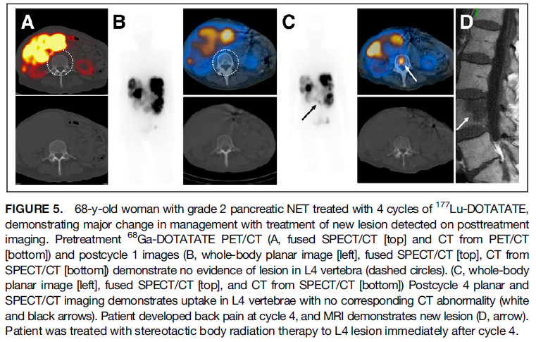 CalaisJeremie's tweet image. SPECT images obtained +24h after administration of Lu177 therapy can provide valuable information and can impact patient management. #theranostics
@JournalofNucMed  @thomashopemd @shiningsurekha  
jnm.snmjournals.org/content/65/3/4…