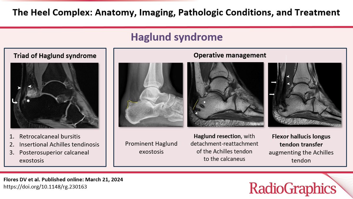 The Heel Complex: Anatomy, Imaging, Pathologic Conditions, and Treatment Flores DV et al. MSK Imaging doi.org/10.1148/rg.230… @dyannotdiane @uOttawaRad @mskbradiologist #RGphx 7/12