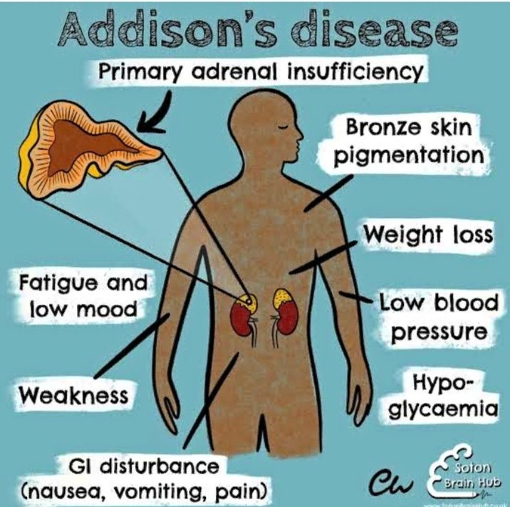 📙𝗣𝗵𝗮𝗿𝗺𝗮𝗰𝗼𝗹𝗼𝗴𝘆

📝The corticosteroid preferred for replacement therapy in #Addison's disease is 🤔🤔🤔

A) Aldosterone 
B) Betamethasone 
C) Fludrocortisone
D) Hydrocortisone 

#medx
#MedEd 
#MedTwitter