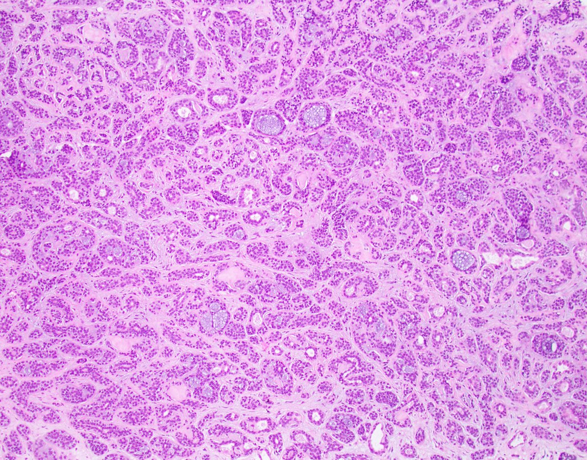 Benign morphology, almost benign biology in the breast, often deadly biology in the salivary gland. The conundrums of neoplasia will never be resolved. #breastpath #PathTwitter @wusm_pathology