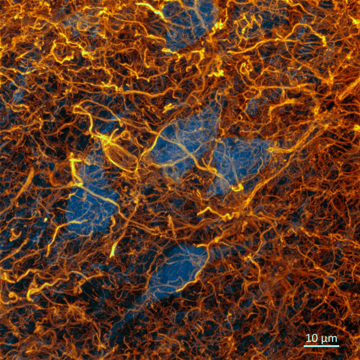 Astrogliosis (🟡) in the human brain 🧠🔬😨. One of the processes occurring in neuroinflammation. These neurons (🔵) are condemned to die... Image taken from the frontal cortex of a patient with advanced Alzheimer's disease (Braak Stage VI) @zeiss_micro #neuroinflammation