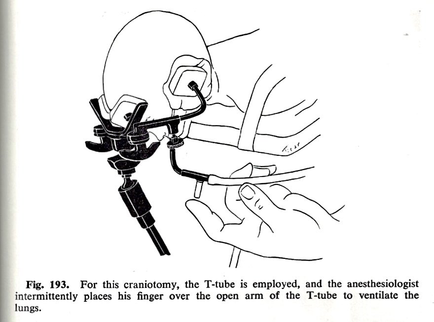 To hyperventilate an infant during craniotomy, the anesthesiologist opened and closed the Ayer's T piece with his finger. Breath sounds were monitored using a precordial stethoscope. Illustration is from Leigh and Belton, 1960.