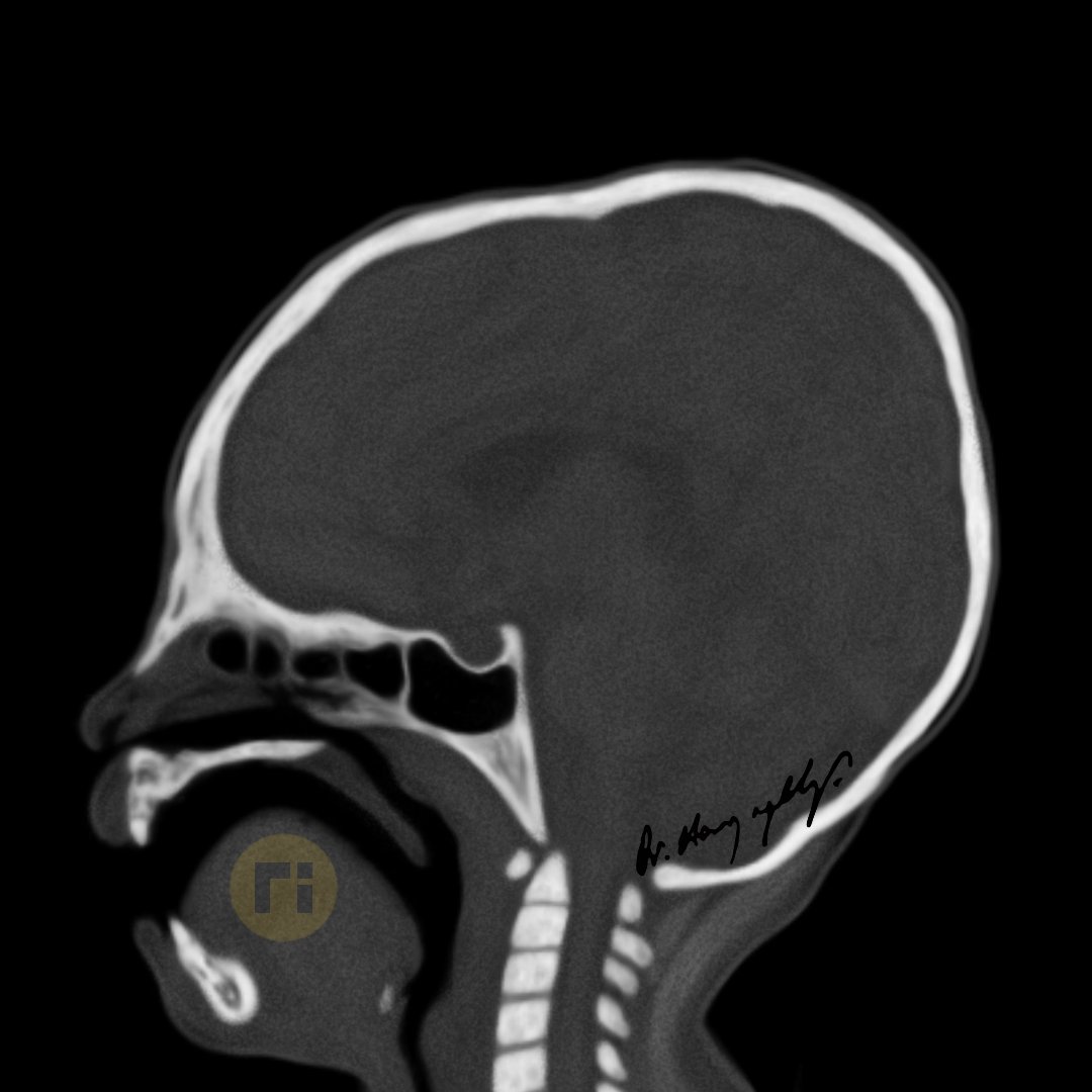 Craniocervical Junction / 1 #radiologicalillustration ✍️ pixel by pixel handmade!