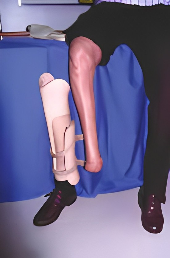 Socket_Health's tweet photo. Thrilled to share our success treating Symes Prostheses! 🦵🌟

At Socket Healthcare, we've achieved breakthroughs in mobility with seamless Symes Prostheses treatment. Transforming lives, one step at a time!

Huge thanks to our dedicated team and resilient patients. Stay tuned https://t.co/RJjlyaz34D
