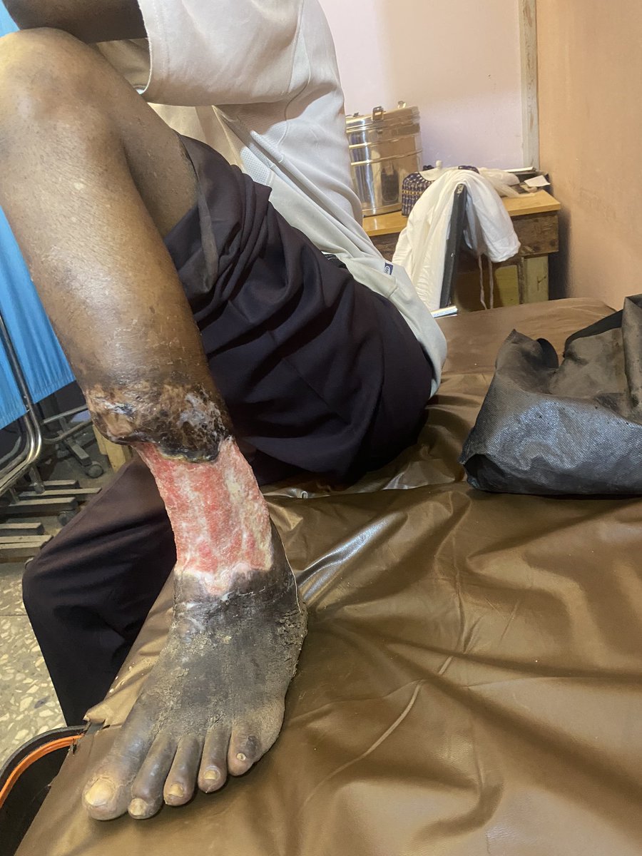 Retweet this as a form of your Friday sadaka,fisabilillah. A patient with the Name Muazu who was a sport coach needs our Urgent Help please. He sustained an injury 10yrs back and has no money to fund his treatment and medications anymore which leads to the injury getting worse…