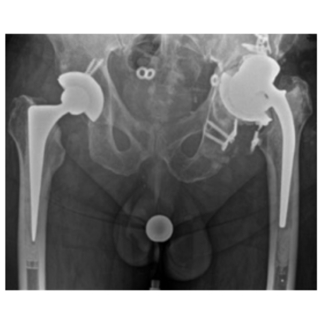 This annotation provides an overview of the evolution of augments, their function, and the outcomes of their use in complex primary and revision THA. #BJJ #TotalHipArthroplasty #Surgeons @sahilsanghavi ow.ly/vX6o50R3qj0