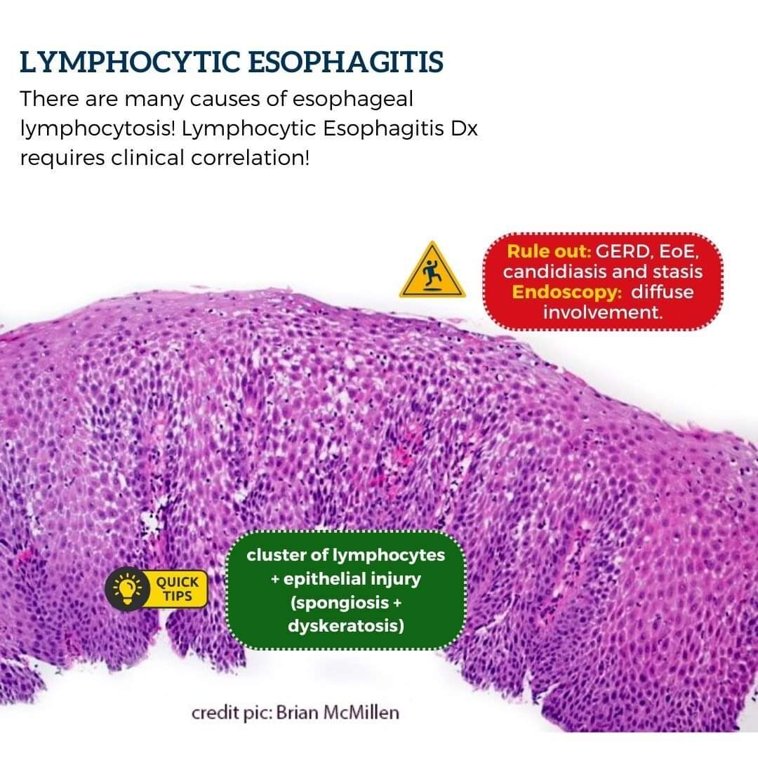 Stay tuned! Do the lymphocytic esophagitis dx if u see cluster of lymphocytes + signs of epithelial injury (spongiosis + dyskeratosis) + excluded GERD, EoE, candidiasis, stasis and endoscopy showing diffuse involvement. In your report, mention associations. #gipath #pathology
