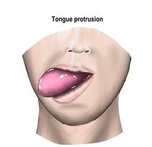 🔍Protrusion of the tongue is primarily brought about by??⬇️
A. Hyoglossus
B. Genioglossus
C. Styloglossus
D. Palatoglossus
#MedTwitter 
#MedEd 
@aestheticd38597 
@VIMABA2