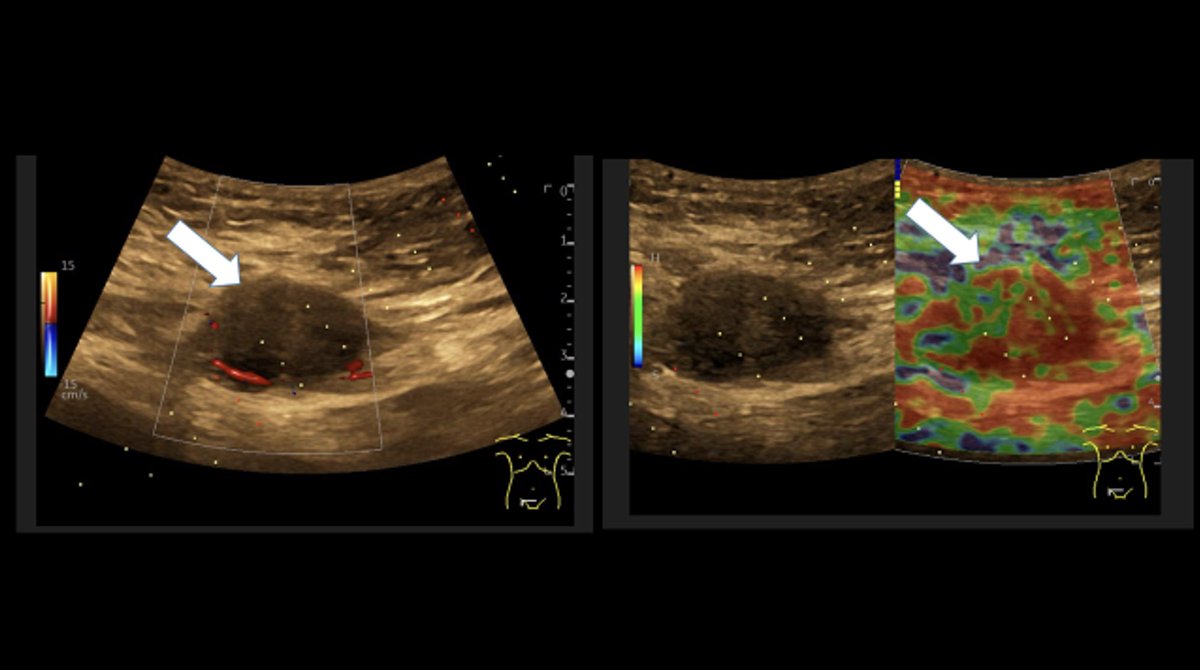 EFSUMB Latest Case of the Month: Unclear lesion of the abdominal wall Take a look at the case here > efsumb.org/unclear-lesion…