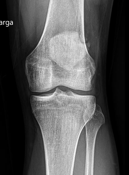 5/4/2024. 🟠 23yo male presents to ED with left #knee 🦵contusion. #XRAY reveals: 1⃣ Superolateral patellar fracture, two displaced fragments. 2⃣ Type III tripartite patella. Let's dive into the diagnosis. MRI and rest of the findings incoming. #MSKrad #Trauma #OrthoTwitter