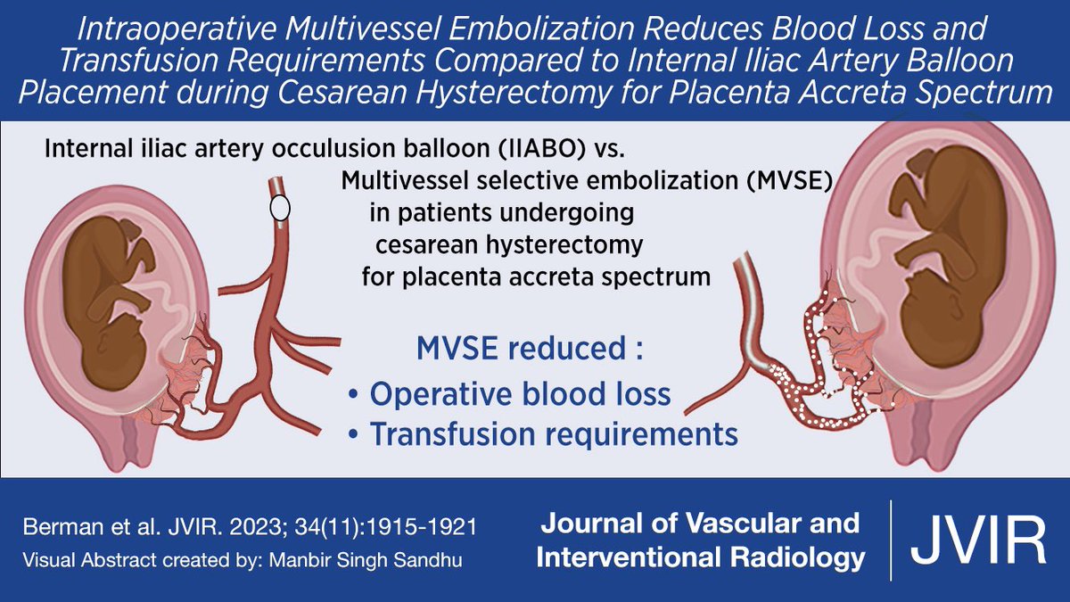Visual abstract from the November issue of <a href="/JVIRmedia/">JVIR</a> on #IRad management &amp; assistance during Cesarean hysterectomy for placenta acreta. 

Thanks to Manbir Singh, a #medicalstudent, for putting together.