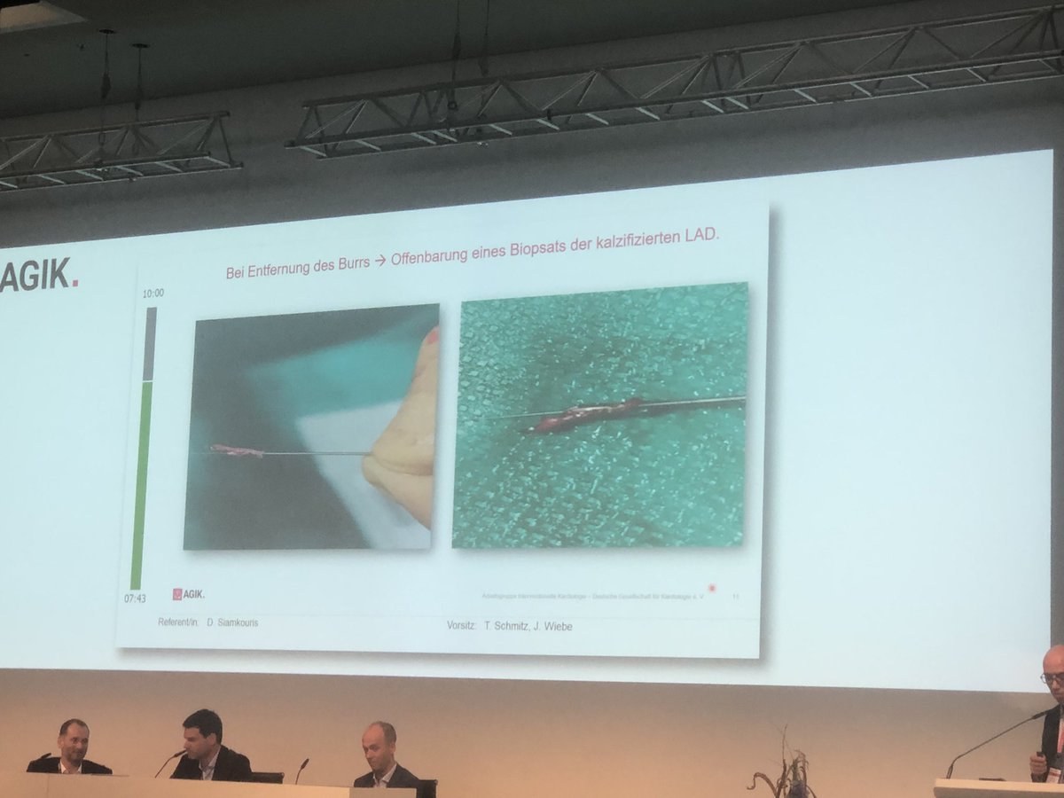 Case Präsentation bei  der <a href="/AGIKinterv/">AGIK</a>  #dgkjt2024 von Dimitrios Siamkouris:

Burr Entrapment während Rotablation erfolgreich mittels Ping Pong Technik behandelt. Beim Rückzug dann erstaunlich viel Material mit herausgezogen.