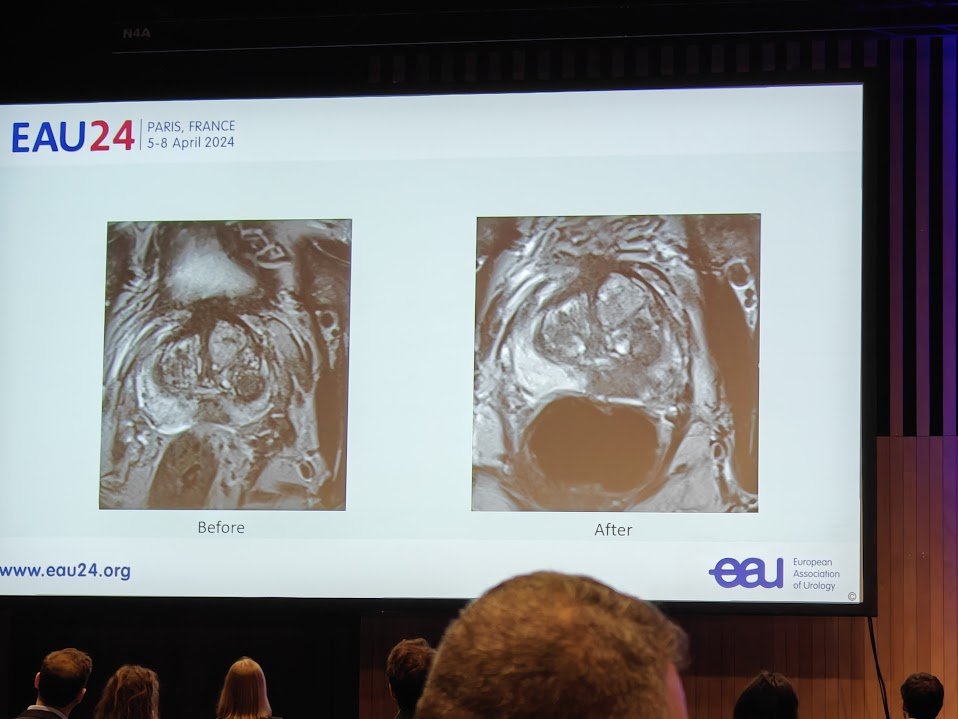 Interesting discussion at #EAU24 @EAUYAUrology session 'Enlarged prostate, rising PSA, -ve biopsies' @ClaudiaKesch emphasising importance of MRI quality, PI-QUAL 3, -ve biopsies Repeat scan, biopsies ISUP 5 Both MRIs, lesion present initially. Did MRI quality affect the case?