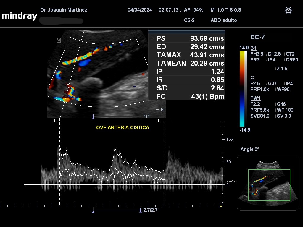 JMMR83's tweet image. Doppler en colecistitis aguda
@NephroP @trigeminy_henry @TaotePOCUS @anaseguragrau @y_interna @yaletung @SonoSamMD @curromir @zbriote @ABCDEcografia @PierpaDiNick @jpalacinp @jorgezzb @AlvarezHigueras @ignaciomsb @EcosemfyC @GTECOSEMI @OswaldoRamosN