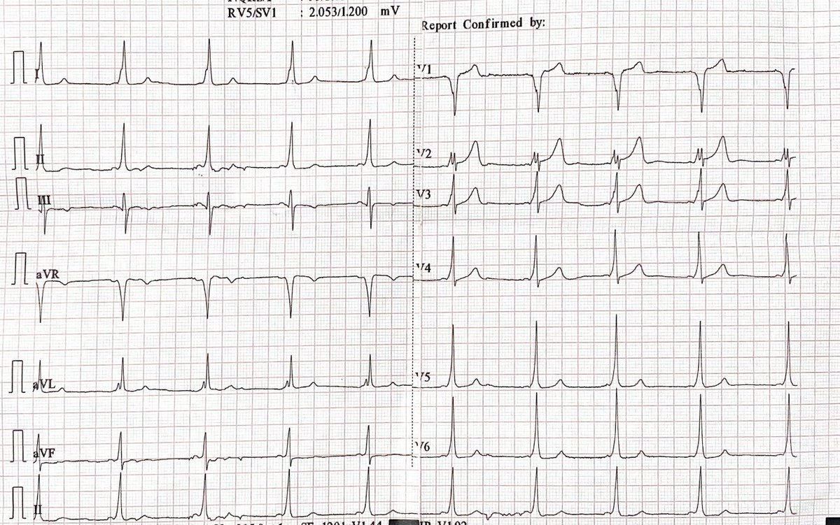 Just see a so prominent delta wave. See V2, is that a separate delta wave leading to that funny QRS?!! Any significance for this appearance? ⁦@syamkumarmd⁩ ⁦@UlhasDr⁩