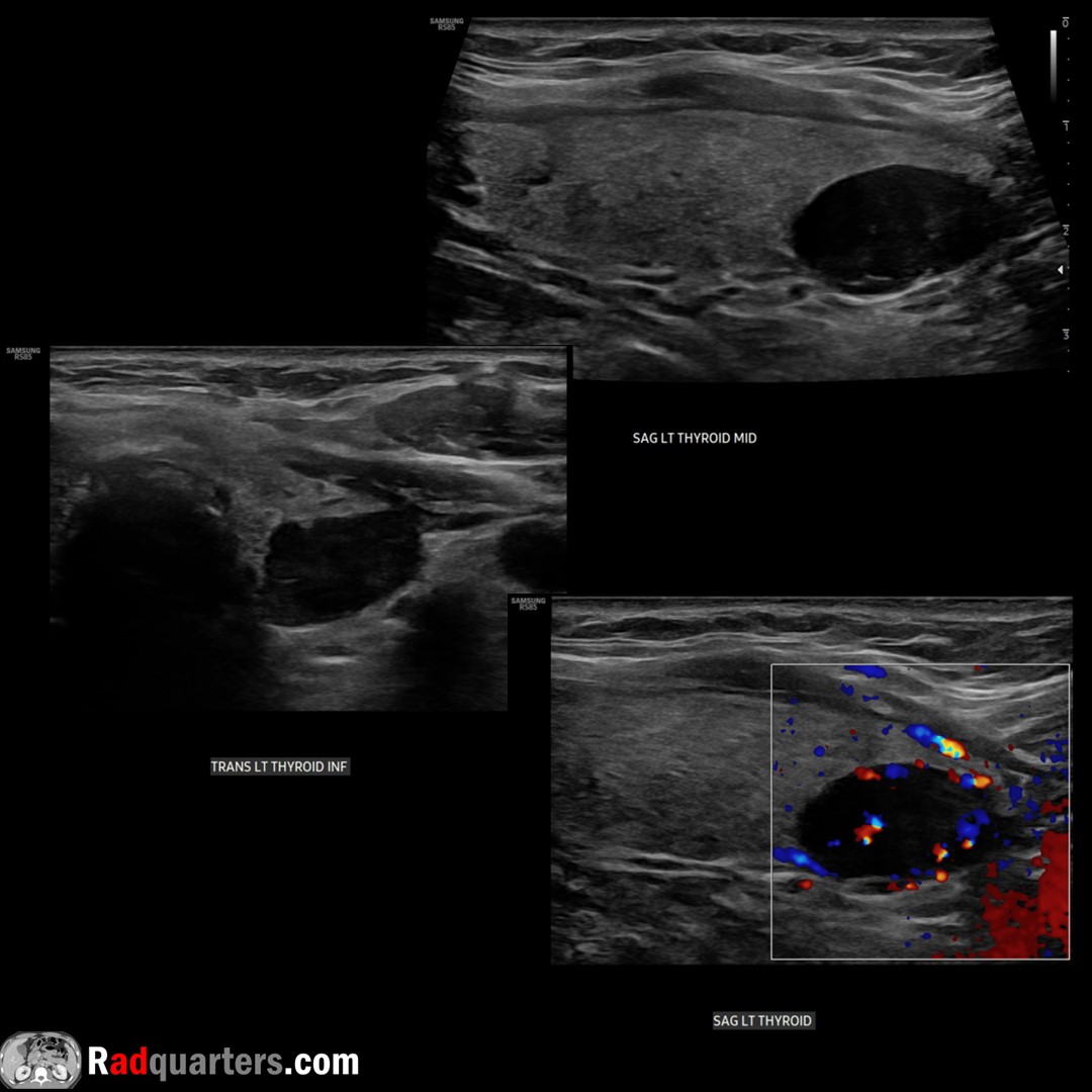 Parathyroid adenoma. Most common cause of primary hyperPTH. Solid, homogeneous & very hypoechoic. Oval/bean-shaped, long axis craniocaudal. Hypervascular. Bright line separates from thyroid. Watch📽️ to learn more: bit.ly/pt-adenoma @BostonImaging @SamsungHealth #FOAMrad