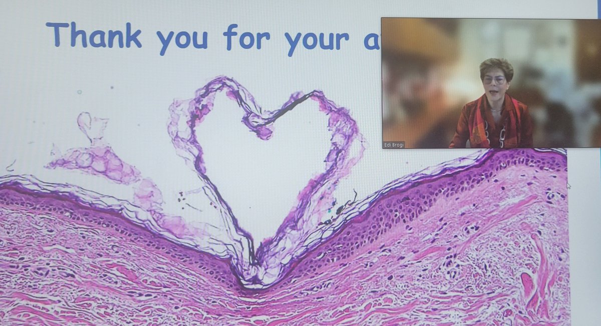 LP_Middleton's tweet image. Thank you @EdiBrogi for delivering an exceptional virtual @MDAndersonNews #path grand rounds on lessons learned w/ molecular testing &amp;amp; #breastpathology. It's  always great to share knowledge to improve the care of our patients with #breastcancer