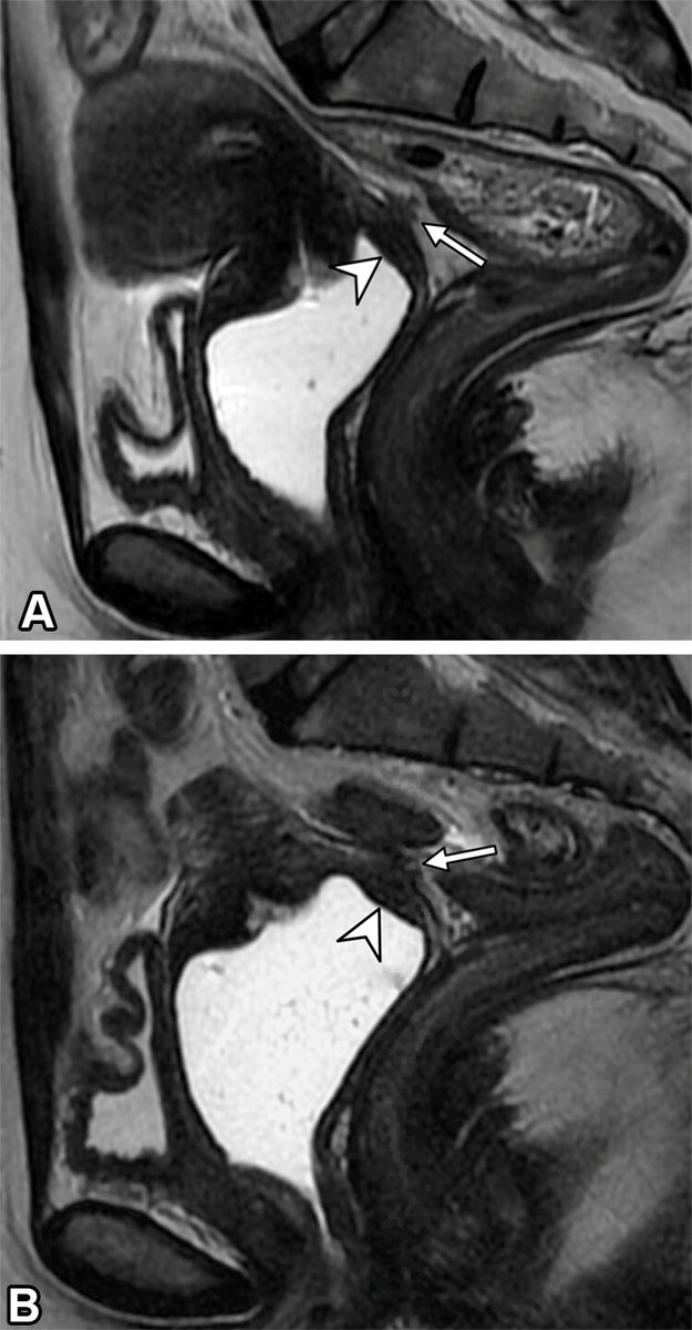 Recognition of common postoperative imaging findings is crucial to differentiate between fibrotic scars and residual disease and/or recurrence of endometriosis. Learn more about postoperative imaging findings here: bit.ly/4cH91Yk @hiltonmlf @Nandoid @CassiaTamura