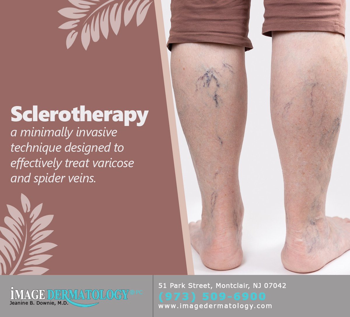 Varicose and spider veins are usually harmless, although their appearance may trouble you. Sclerotherapy is a perfect solution to ease your worries. Schedule your appointment at Image Dermatology P.C. today. #sclerotherapy #montclair #NJ #imagedermatology