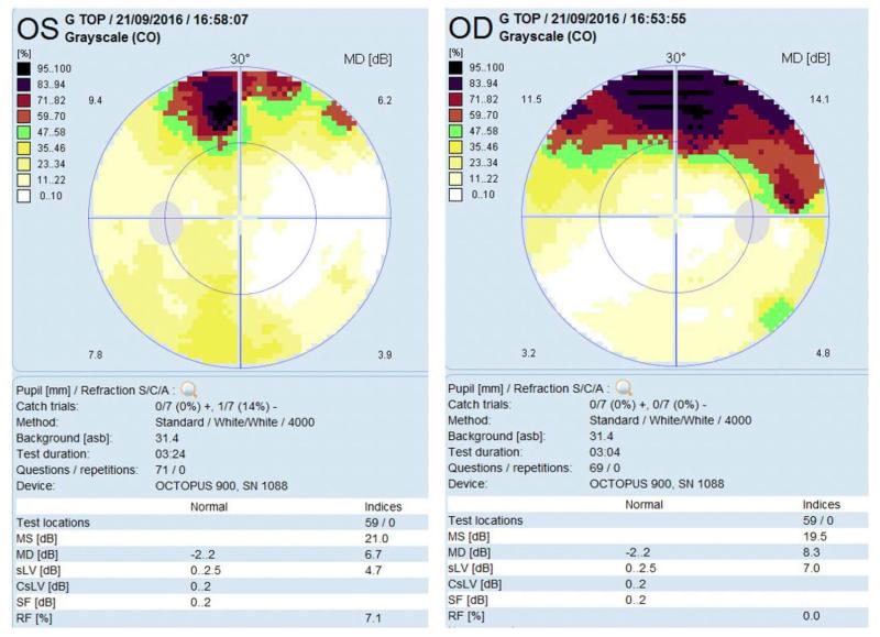 This Eye News article discusses how eyes are the window to the brain & features our Octopus 900 device, which has an extensive library of static test patterns, some of which are suitable for neurological testing hsuk.co/49tsU2a #VisualFieldTesting #Octopus900 #neurology