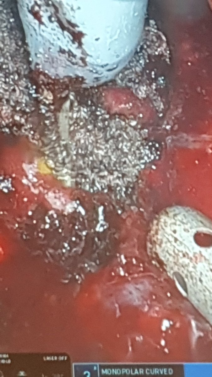 #EAU24 video session02: off clamp , no renorrhapy, no vessels identification #partialnephrectomy
Is this the way how the technique should evolve? Not sure.