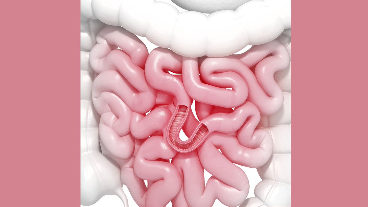 HeidiHmoretti's tweet image. What is SIBO?

SIBO is small intestinal bacterial overgrowth.

In a healthy gut, bacteria don’t grow easily in the small intestine, but they do grow well in the large intestine. 

With SIBO, bacteria grow more readily in the small intestine, and this causes symptoms like gas…