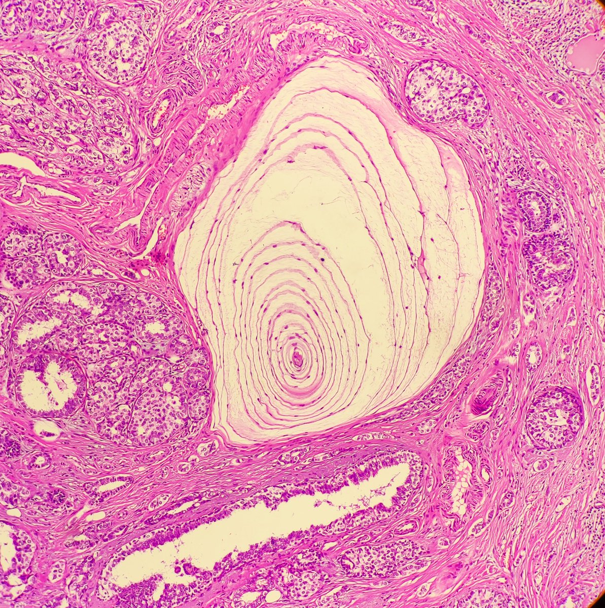 nilufer510's tweet image. 39 years female.İnvasive breast cancer nst with peripacinian invasion.