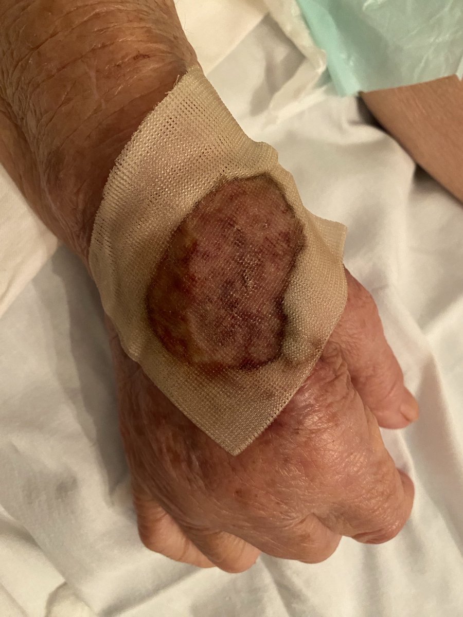 ccs_anna's tweet image. Lesiones en la piel por infección en las vías de acceso en paciente en la #PoliclínicaMetropolitana en Caracas. Otras lesiones se encuentran en áreas privadas. Facturan costos del primer mundo, pero la atención médica es del tercer mundo. #incompetentes #derechosdelpaciente #OMS