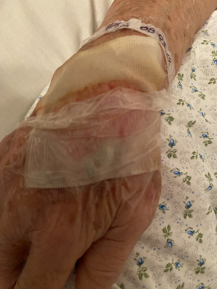 ccs_anna's tweet image. Lesiones en la piel por infección en las vías de acceso en paciente en la #PoliclínicaMetropolitana en Caracas. Otras lesiones se encuentran en áreas privadas. Facturan costos del primer mundo, pero la atención médica es del tercer mundo. #incompetentes #derechosdelpaciente #OMS