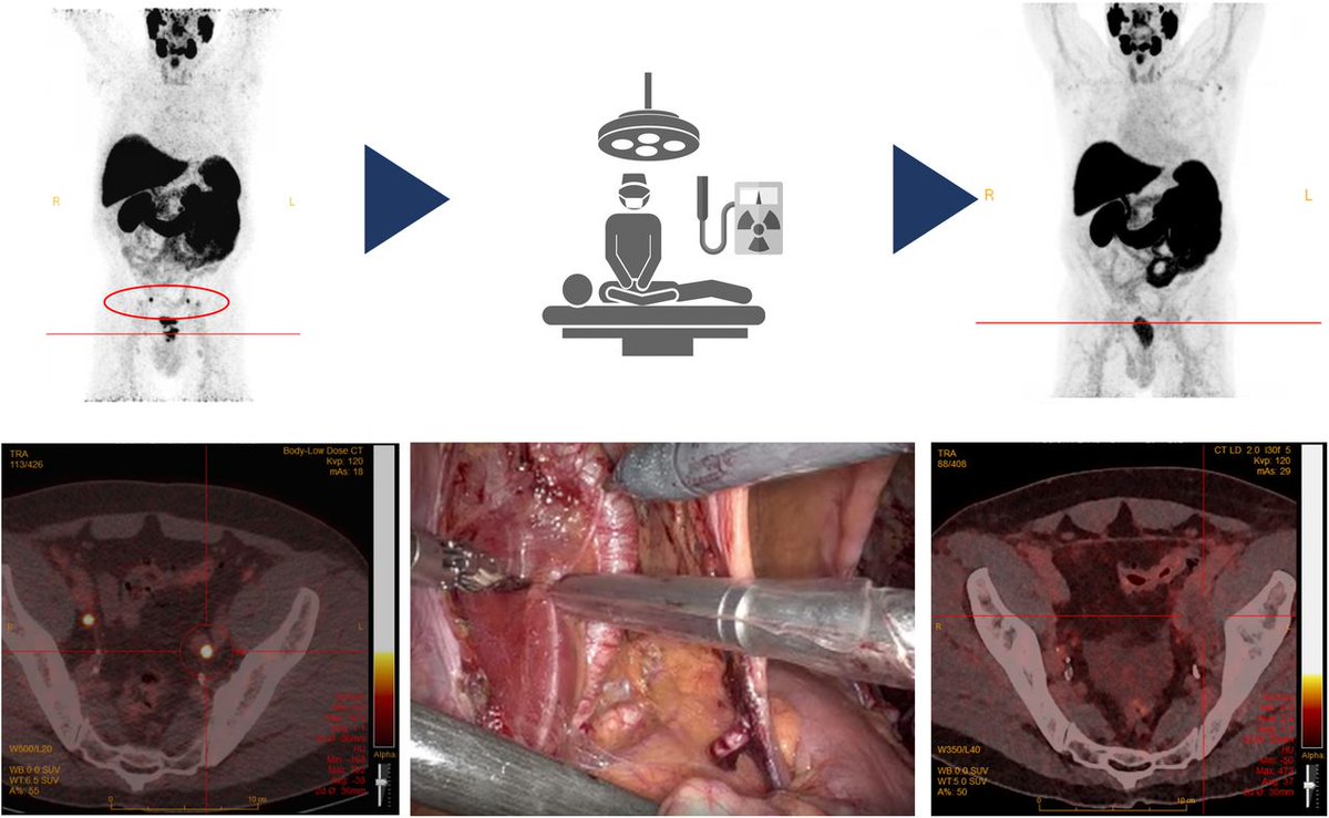 Radioguided surgery accurately detects and removes metastatic lymph nodes in newly diagnosed #ProstateCancer patients: ow.ly/e44Z50QUoQ4 #NuclearMedicine #PSMA