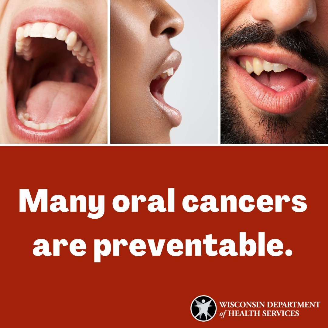 Many oral cancers are preventable. Visit the dentist regularly for an #OralCancerScreening and take action: ⏺ Get vaccinated against HPV ⏺ Don't use commercial tobacco ⏺ Limit alcohol ➡ Learn more about preventing #OralCancer: dhs.wisconsin.gov/publications/p… #OralCancerAwarenessMonth