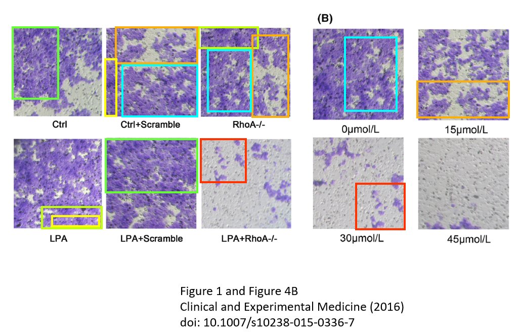 Oopsies. Courtesy of @SpringerNature's journal Clinical and Experimental Medicine and researchers from First Affiliated Hospital of Xi’an Jiaotong University. pubpeer.com/publications/9…