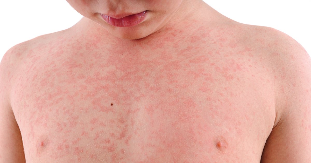 The CDC issued a warning that the vaccination rate for measles among U.S. kindergarteners has fallen below the herd immunity rate of about 95% -- and it's so contagious that 9 out of 10 unprotected people who are exposed may get sick. wb.md/3VSg9LD