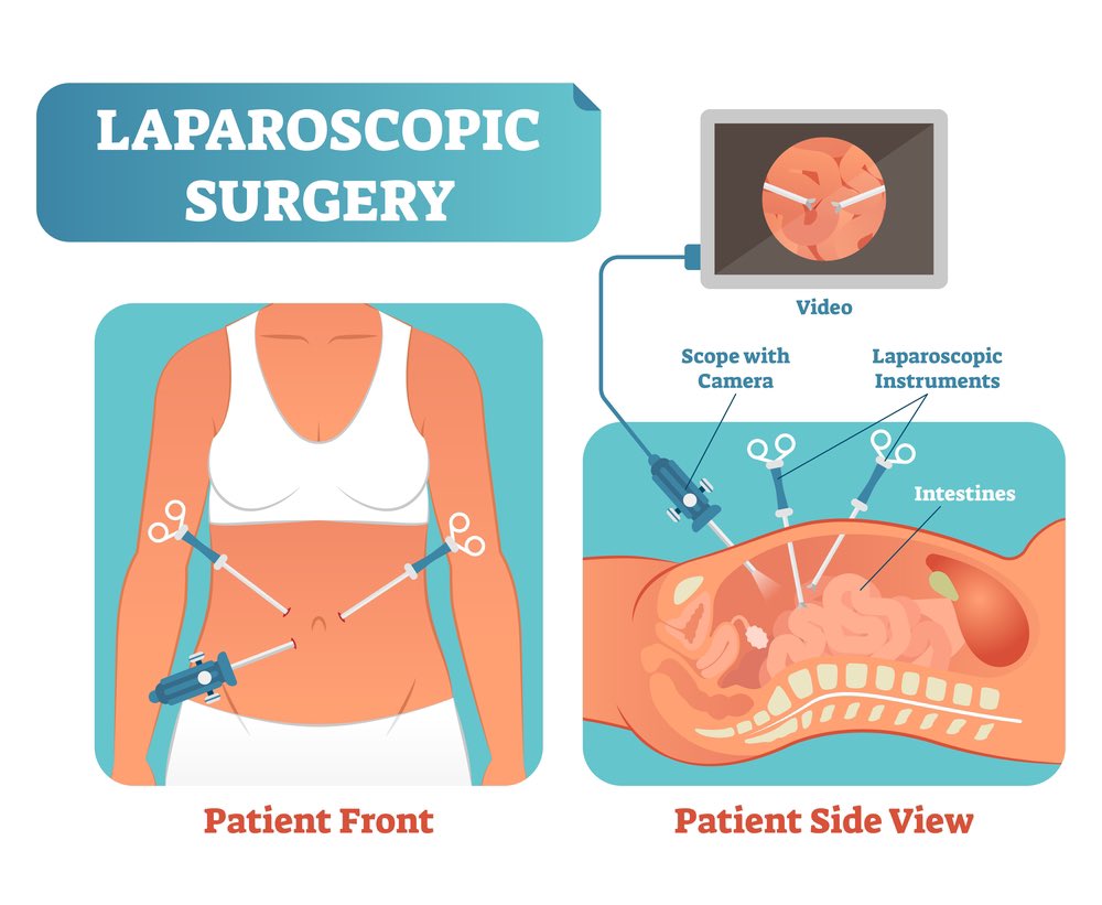 Laparoscopic surgery is wild