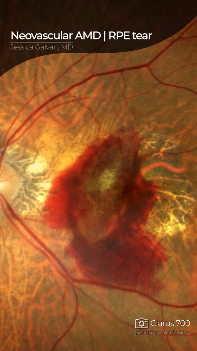 RPE tears in AMD show a clear demarcation line with contrasting pigmentation and disrupted tissue layers. Can be accompanied by subretinal hemorrhage. #RPEtear #SubretinalHemorrhage #AMDAwareness #Clarus700 #RetinalDisease