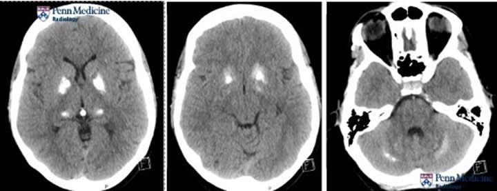 29-year-old woman presenting with migraines and worsening headache - Auntminnie #radiology @PennMedicine buff.ly/4cWAA04