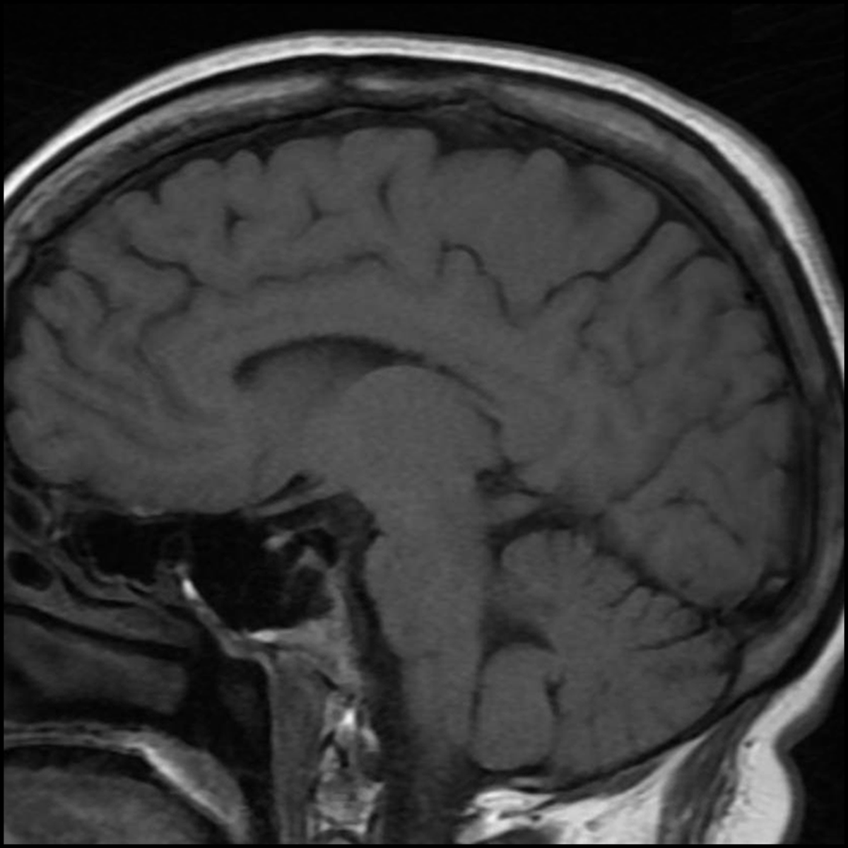 In healthy unanesthetized volunteers, norepinephrine increased arterial pressure but decreased cerebral blood flow. Cerebral blood flow was correlated with cardiac output, not with arterial blood pressure. Read more in @_Anesthesiology: ow.ly/ysB950RaShY 
  
#anesthesiology