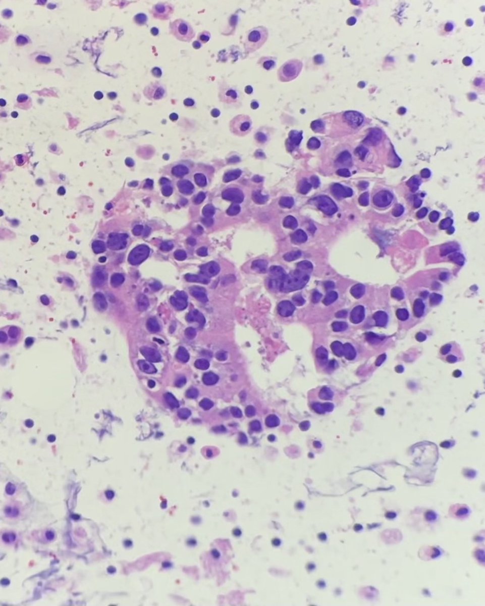 Cytology #fluidfriday 💉
Pleural fluid: PAP and cell block 🔬

How would you call this? 
What stains would you order to work up tumor of unknown origin?

 #cytopath #PathTwitter