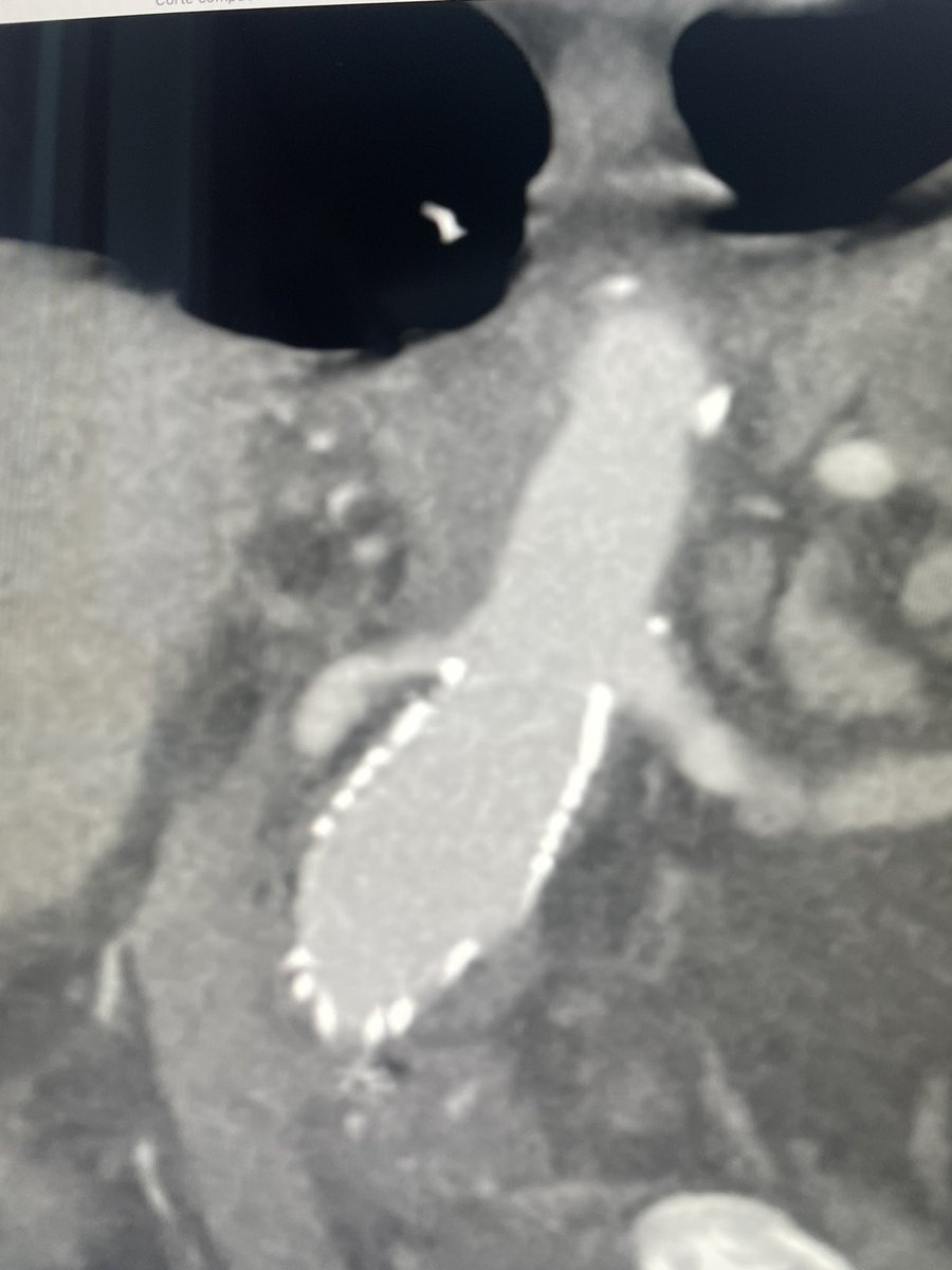 Vascular 'Dragron Khan' anatomy on a ruptured giant right iliac aneurysm plus AAA aneurysm with short infrarenal neck. High risk patient. Challenging right hypo embolization + GORE Excluder. Tough to navigate through intraop but look at this amazing conformability #aortaEd