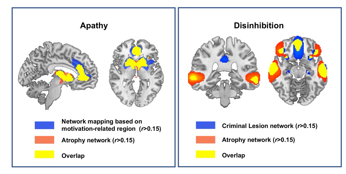 Chu et al. identify specific atrophy networks associated with different clinical subtypes of frontotemporal dementia, and with apathy and disinhibition, and propose that the findings will aid the selection of future neuromodulation targets. tinyurl.com/p8873wk7
