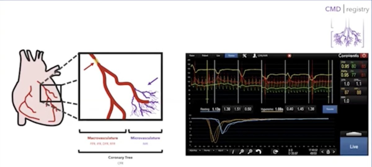 From Chest Pain to #Coronary Function Testing: Clinical and Economic Impact of Coronary Microvascular Dysfunction #CMD with @BCase07 and @IlanMerdler crtonline.org/video-detail/f…