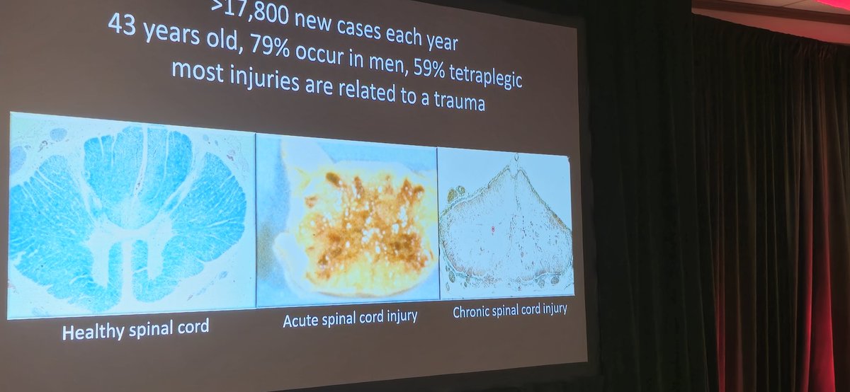 I had no idea there were so many new cases each year (nearly 18,000! And I think these are just the reported injuries). Presentation on 
 recovery from #spinal cord #injury. #ASNR2024 #science #neuroscience #neuro #neurorehabilitation #asnr24 #asnr #neurorehab