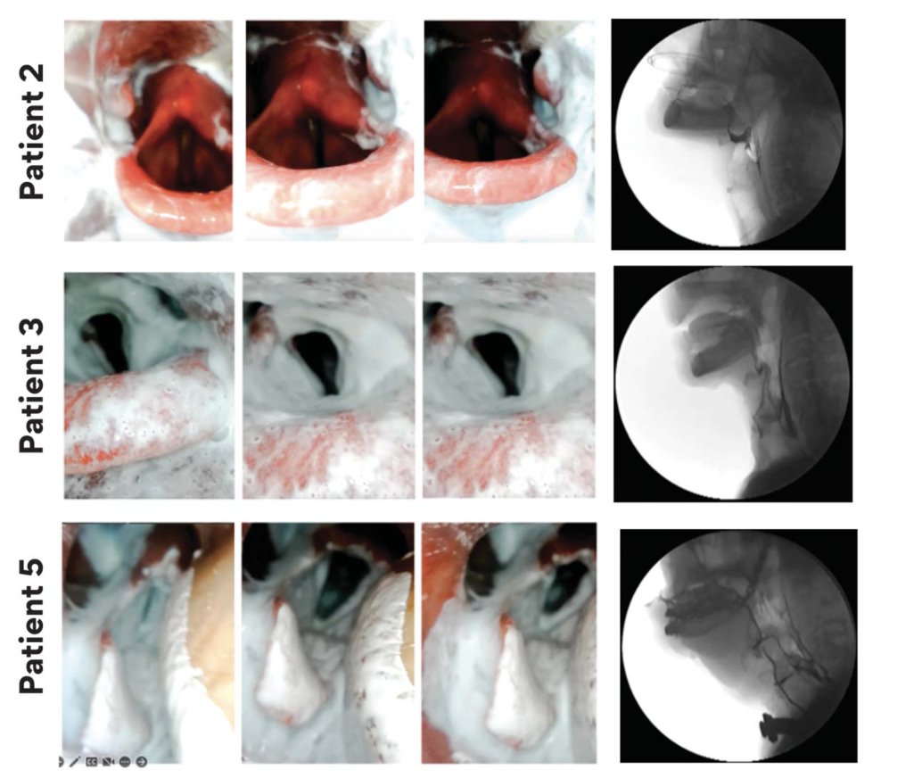 Are you a #medslp that performs bedside 🛌 #swallow evaluations to assess #dysphagia ⚕️🫁without access to #FEES or #MBS? Then check out this innovative and clinically meaningful #SEES-related research📚 by Jose Vergara👨‍⚕️, @annacmiles👩‍⚕️, & colleagues (tinyurl.com/SEESwithLowCos…)