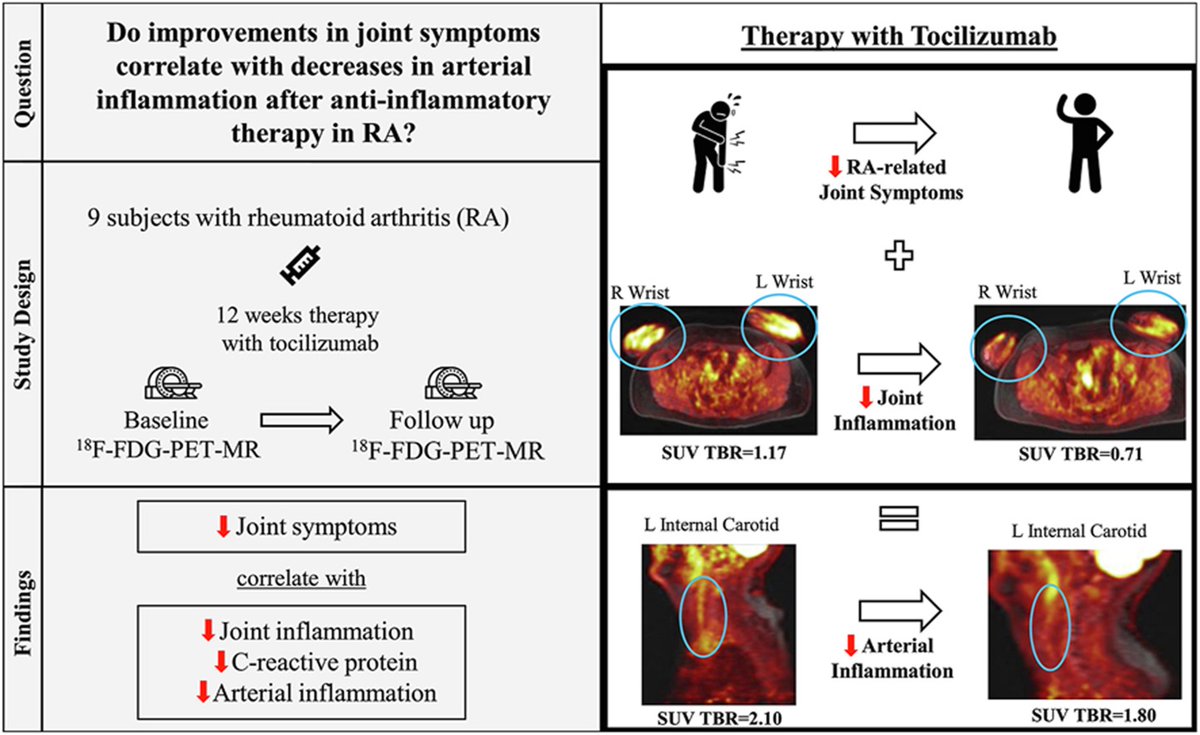 In this pilot study of patients with rheumatoid arthritis, improvement in symptoms with tocilizumab was associated with improvement in FDG uptake on PET/CT. @HadilZureigat @mghcvrc Read now👉bit.ly/3Q1ePCt #CVNuc @MyASNC