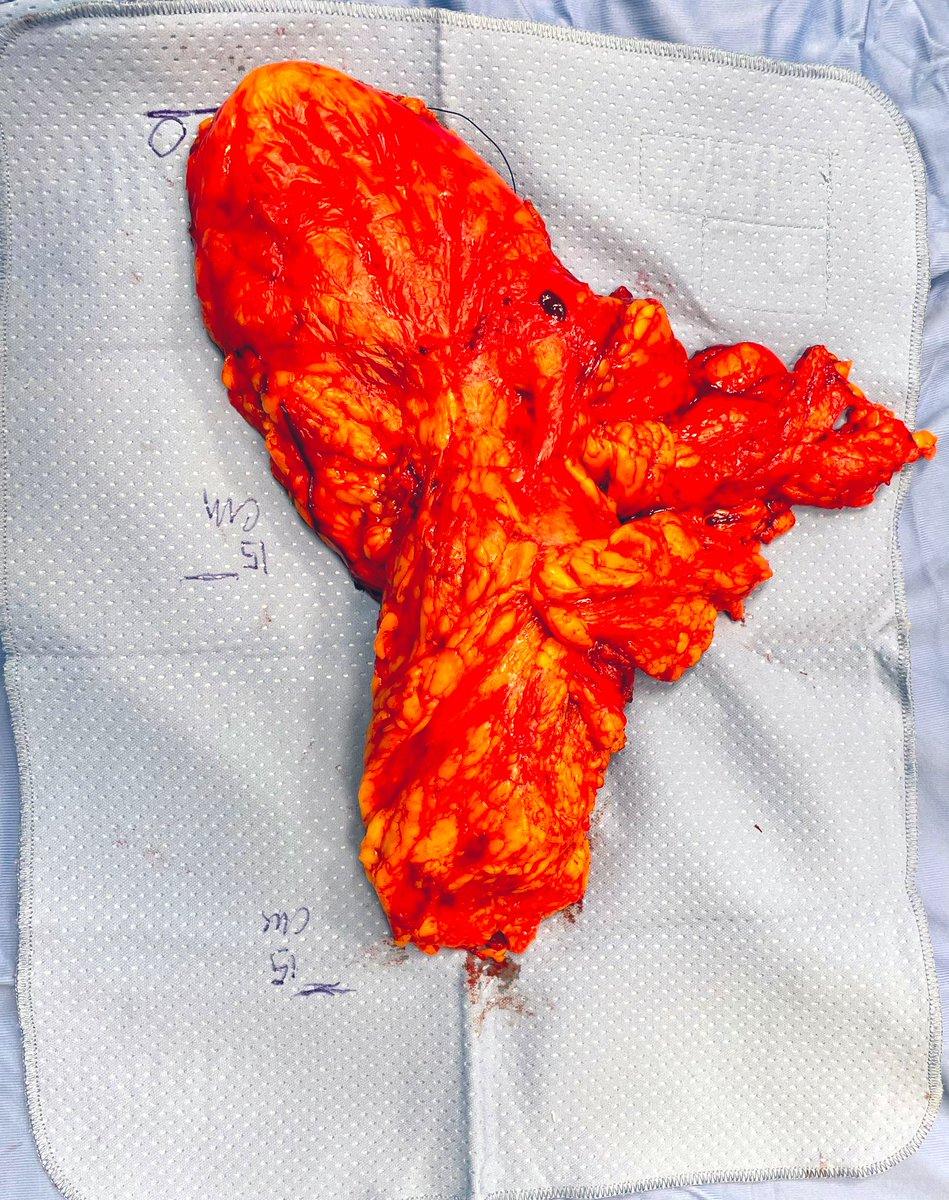 Not only minimally invasive surgery on friday😉 and you? What happens today? @Mohamedendourol @PuliattiStefano @so_uro Left open subcostal nephrectomy for abscess & hemorragic cyst