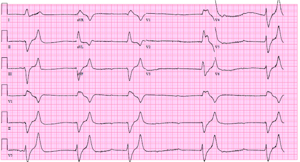 The heart is a chemical battery, and does not tolerate acidosis and hyperkalemia.