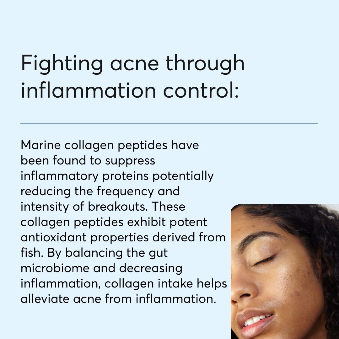 MDacne's tweet photo. Collagen, the most abundant protein in the body, plays a crucial role in maintaining the skin's firmness, suppleness, and overall condition. However, the question remains: does collagen help with acne?

Here are some benefits of using collagen for acne 
https://t.co/jnIoOoNSVt https://t.co/bja7QvP0vV