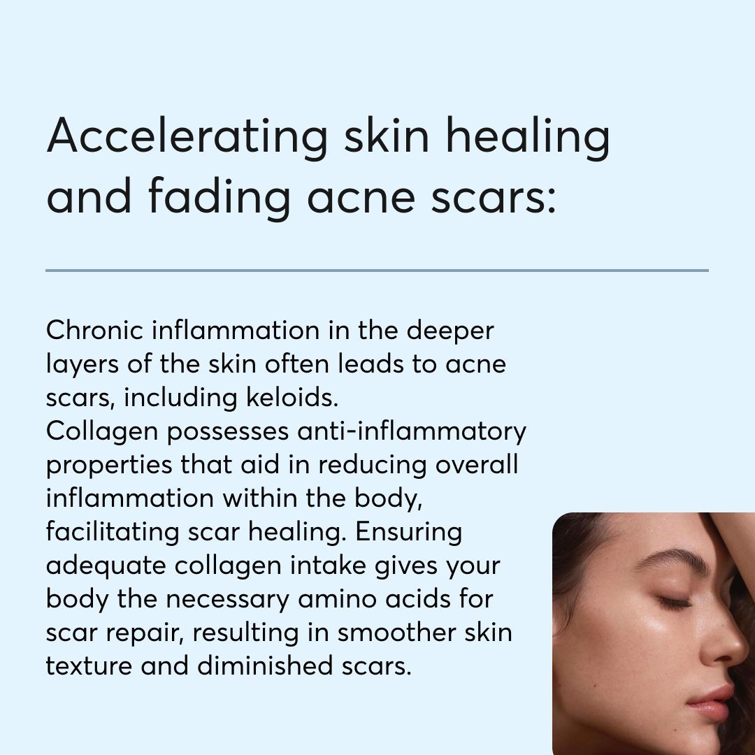 Collagen, the most abundant protein in the body, plays a crucial role in maintaining the skin's firmness, suppleness, and overall condition. However, the question remains: does collagen help with acne?

Here are some benefits of using collagen for acne 
mdhair.co/products/marin…